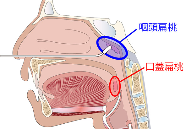 上咽頭の口頭扁桃と口蓋扁桃に塗付します